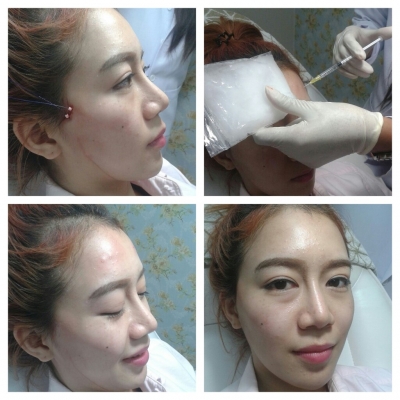 ร้อยไหม 8มิติ หน้าสวยครบวงจร แบบไม่เขียว ไม่ช่ำ หน้าเป๊ะเวอร์ 081-713-3783 ร้อยไหม 8มิติ หน้าสวยครบวงจร แบบไม่เขียว ไม่ช่ำ หน้าเป๊ะเวอร์ 081-713-3783