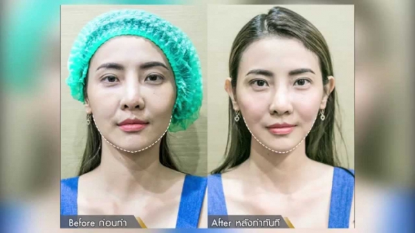 ร้อยไหม 8มิติ หน้าสวยครบวงจร แบบไม่เขียว ไม่ช่ำ หน้าเป๊ะเวอร์ 081-713-3783 ร้อยไหม 8มิติ หน้าสวยครบวงจร แบบไม่เขียว ไม่ช่ำ หน้าเป๊ะเวอร์ 081-713-3783