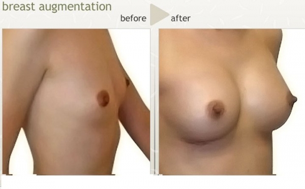 โปรโมรชั้น Veser Lipo ร้อยไหม 7มิติ สเตมเซลล์ 089-816-5225