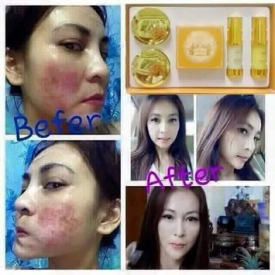 Gold Set ชุดกำจัดสิว หน้าสวยใส ลบฝ้า กระ รอยดำจากสิว 0898165225 ID : ouithaiand Gold Set ชุดกำจัดสิว หน้าสวยใส ลบฝ้า กระ รอยดำจากสิว 0898165225 ID : ouithaiand
