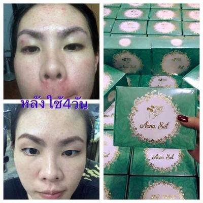 Gold Set ชุดกำจัดสิว หน้าสวยใส   ลบฝ้า กระ รอยดำจากสิว 0898165225 ID : ouithaiand