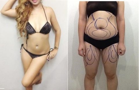 สถาบันเสริมความงามครบวงจร ฉีดเสริมหน้าอก 081-713-3783