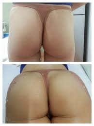 สถาบันเสริมความงามครบวงจร ฉีดเสริมหน้าอก 081-713-3783
