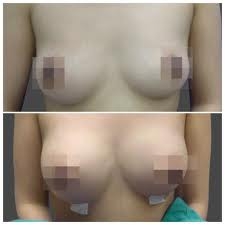 สถาบันเสริมความงามครบวงจร ฉีดเสริมหน้าอก 081-713-3783 สถาบันเสริมความงามครบวงจร ฉีดเสริมหน้าอก 081-713-3783