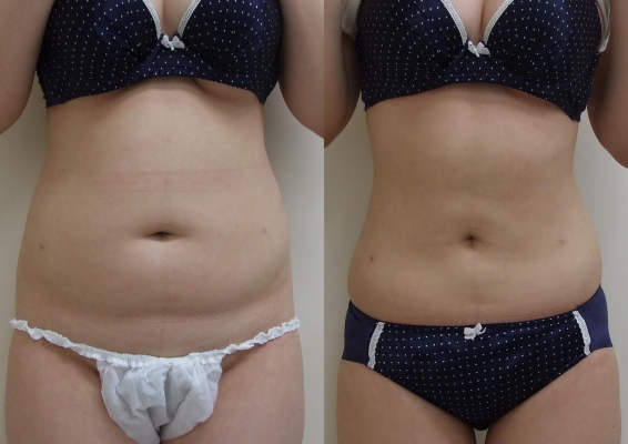 สถาบันเสริมความงามครบวงจร ฉีดเสริมหน้าอก 081-713-3783