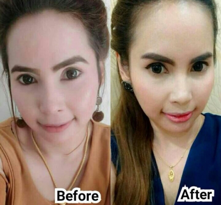 สถาบันเสริมความงามครบวงจร ฉีดเสริมหน้าอก 081-713-3783