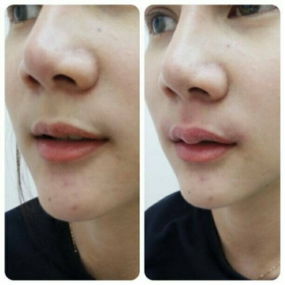 สถาบันเสริมความงามครบวงจร ฉีดเสริมหน้าอก 081-713-3783