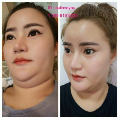 สถาบันเสริมความงามครบวงจร ฉีดเสริมหน้าอก 081-713-3783