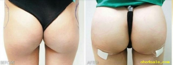 สถาบันเสริมความงามครบวงจร ฉีดเสริมหน้าอก 081-713-3783