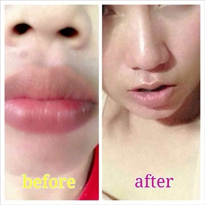 สถาบันเสริมความงามครบวงจร ฉีดเสริมหน้าอก 081-713-3783