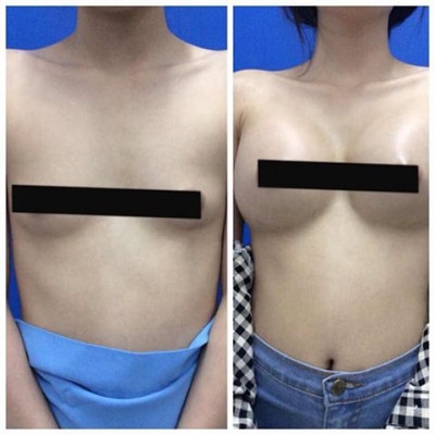 ฉีดเสริมหน้าอก โบทอกหน้าเรียว ร้อยไหม 4 มิติ ไหมทองคำ IPL ลบฝ้า 081-713-3783 ฉีดเสริมหน้าอก โบทอกหน้าเรียว ร้อยไหม 4 มิติ ไหมทองคำ IPL ลบฝ้า 081-713-3783