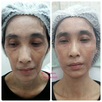 ฉีดเสริมหน้าอก โบทอกหน้าเรียว ร้อยไหม 4 มิติ ไหมทองคำ IPL ลบฝ้า 081-713-3783 ฉีดเสริมหน้าอก โบทอกหน้าเรียว ร้อยไหม 4 มิติ ไหมทองคำ IPL ลบฝ้า 081-713-3783