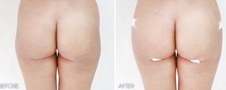 ฉีดเสริมหน้าอก โบทอกหน้าเรียว ร้อยไหม 4 มิติ ไหมทองคำ IPL ลบฝ้า 081-713-3783 ฉีดเสริมหน้าอก โบทอกหน้าเรียว ร้อยไหม 4 มิติ ไหมทองคำ IPL ลบฝ้า 081-713-3783