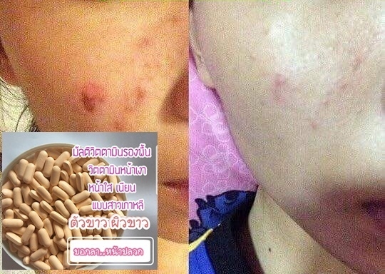 กลูต้าผิวขาว รกแกะหน้าเด็ก โบท็อกหน้าเรียว เพิ่มอก สมุนไพรยาสอด พร้อมส่งค่ะ