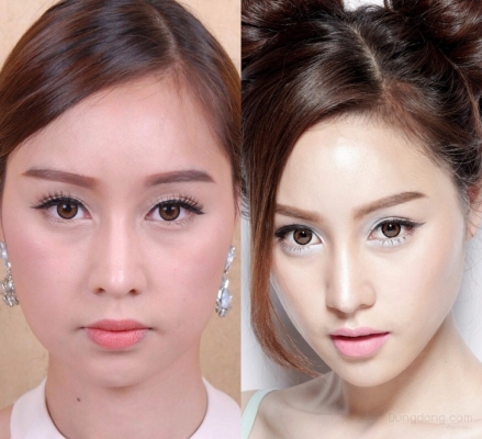 ร้อยไหมสเต็มเซลล์ Premuim- QSW Veser-SLBD สลายไขมัน  ฉีดเสริมหน้าอก 0827078761