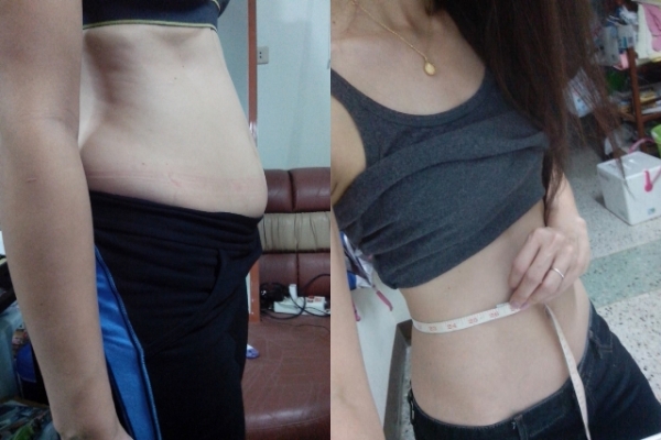 ร้อยไหมสเต็มเซลล์ Premuim- QSW Veser-SLBD สลายไขมัน  ฉีดเสริมหน้าอก 0827078761