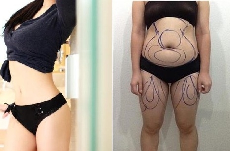 ร้อยไหมสเต็มเซลล์ Premuim- QSW Veser-SLBD สลายไขมัน  ฉีดเสริมหน้าอก 0827078761