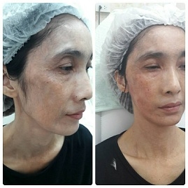 ร้อยไหมสเต็มเซลล์ Premuim- QSW Veser-SLBD สลายไขมัน  ฉีดเสริมหน้าอก 0827078761