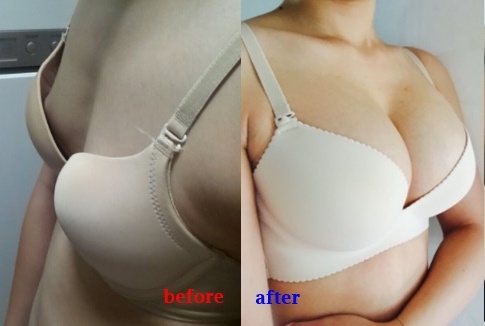 ร้อยไหมสเต็มเซลล์ Premuim- QSW Veser-SLBD สลายไขมัน  ฉีดเสริมหน้าอก 0827078761