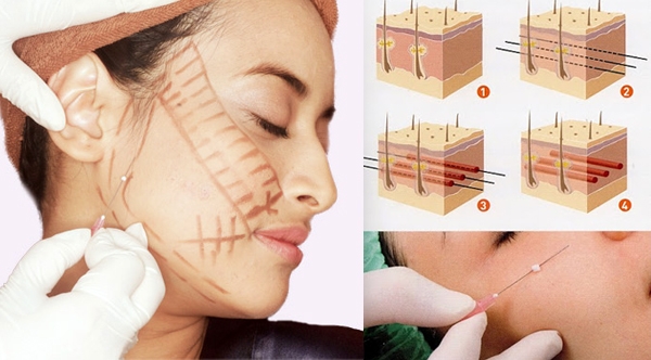 ร้อยไหมสเต็มเซลล์ Premuim- QSW Veser-SLBD สลายไขมัน  ฉีดเสริมหน้าอก 0827078761