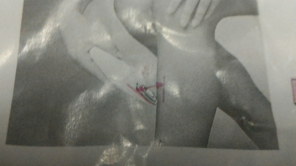 เครื่องถอดกำจัด ยี่ห้อ EPILADY ของประเทศ อิสราเอล เป็นแบบใช้การทำงานของสปริงในการหดรัด ทำงานได้เร็วไม่มีคมไม่มีอันตรายจาการโดนบาด