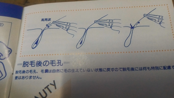 อุปกรณ์กำจัดขนด้วยไฟฟ้ายี่ห้อ TEXE รูขุมขนไม่ใหญ่ ตามส่วนต่างๆของร่างกาย จากญี่ปุ่น ด้วยการใช้กระแสไฟฟ้าอ่อนๆ ทำให้รากของขนแห้ง และถอนออกง่ายๆ